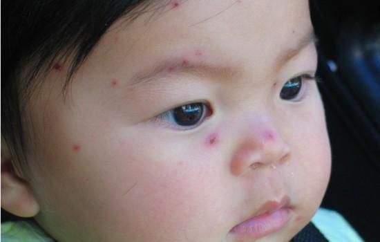 水痘可以吃小瓜吗,小瓜的适宜与否探讨